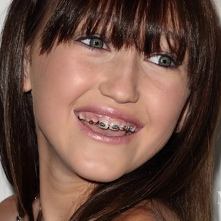 Did Noah Cyrus Get Veneers