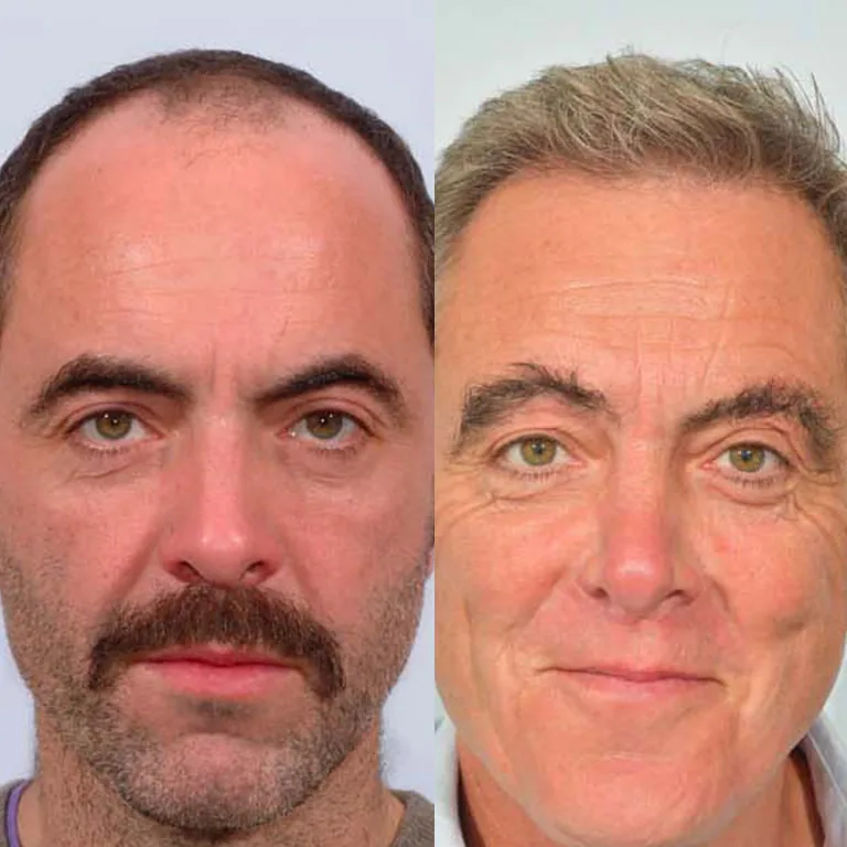 James Nesbitt Hair Transplant FUE or DHI