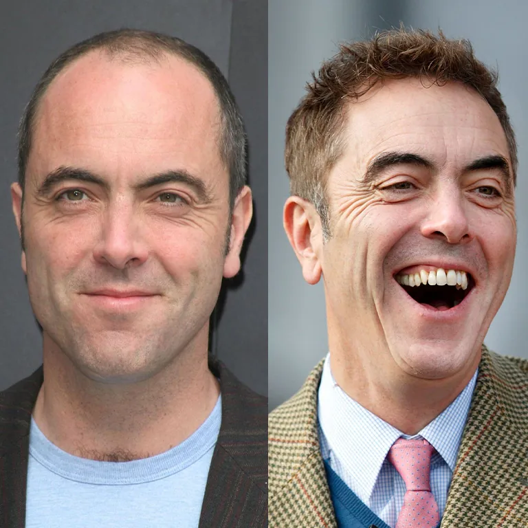 James Nesbitt Hair Transplantation Story