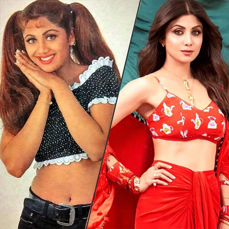 Shilpa Shetty Botox and Fillers