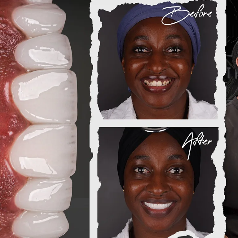 Smile Makeover Transformation 2025