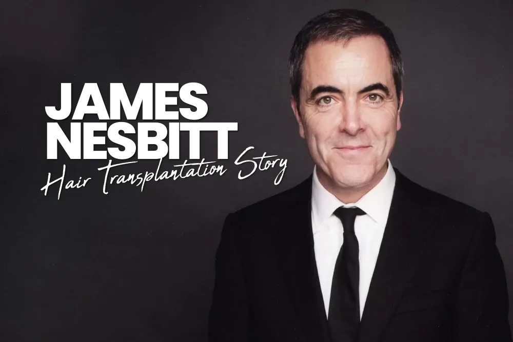 The James Nesbitt Hair Transplant