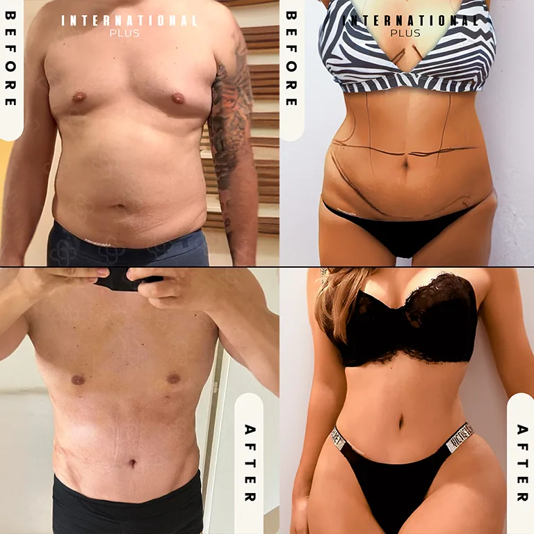 Vaser Liposuction Before and After