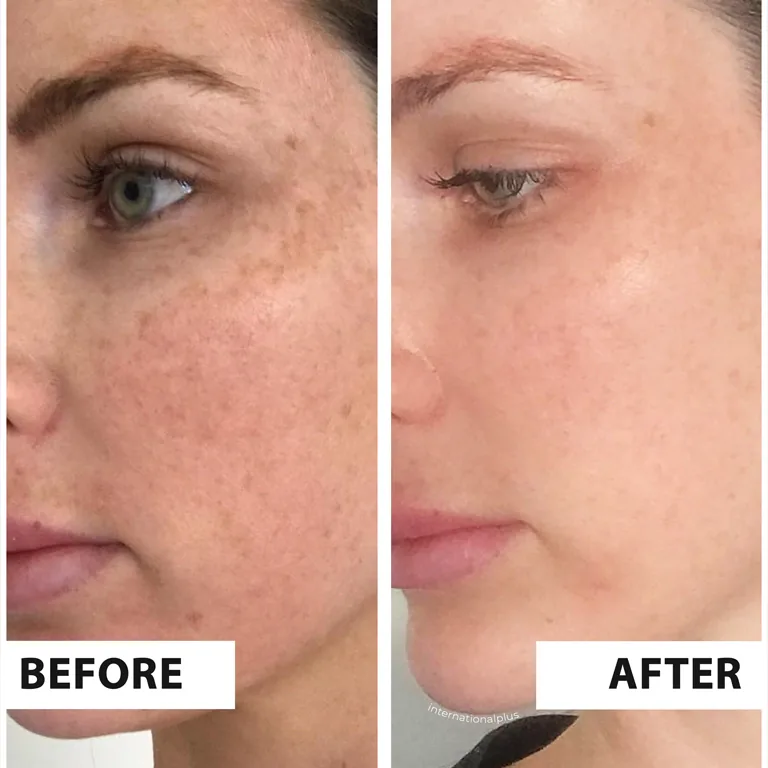 Botox Before and After 2025