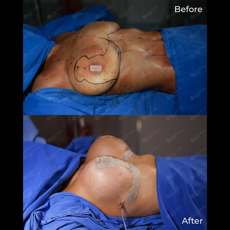 Breast Lift Turkey Reviews