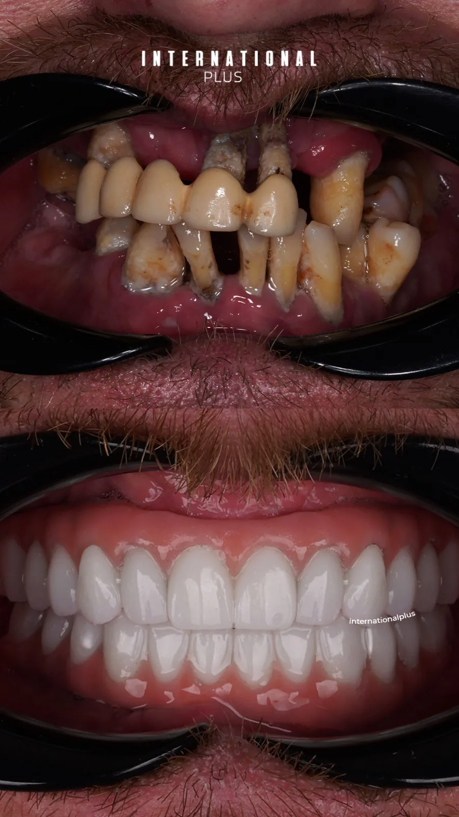 Cheap Dental Implants Turkey 2025