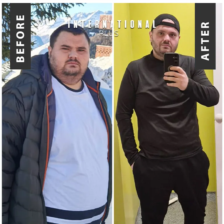 Gastric Bypass Before and After