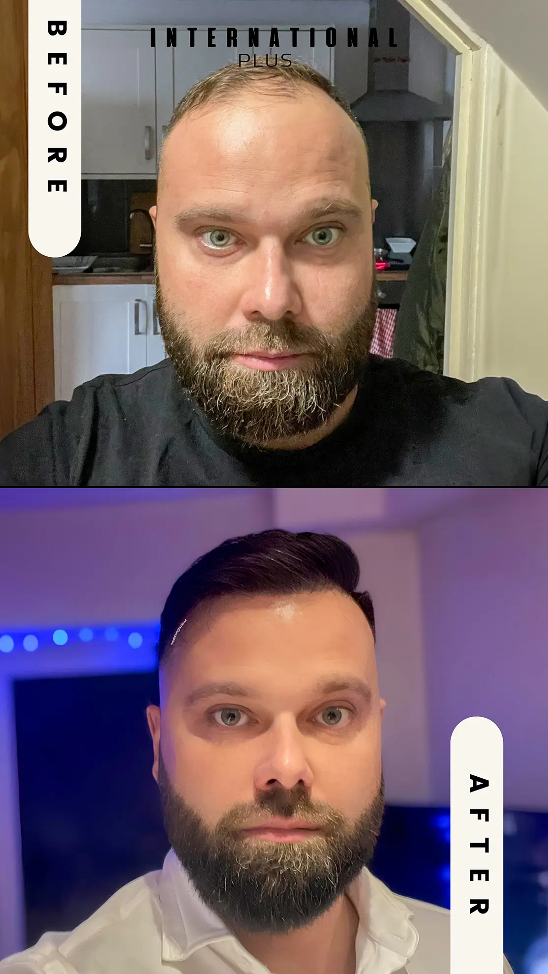 Hairline Restoration Before After