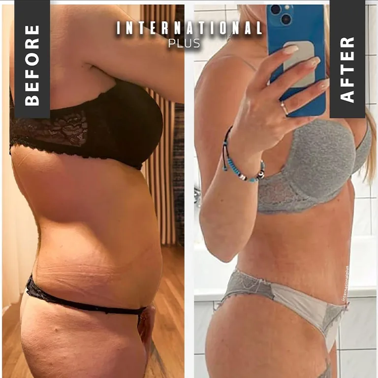 BBL and Lipo 360 Before After