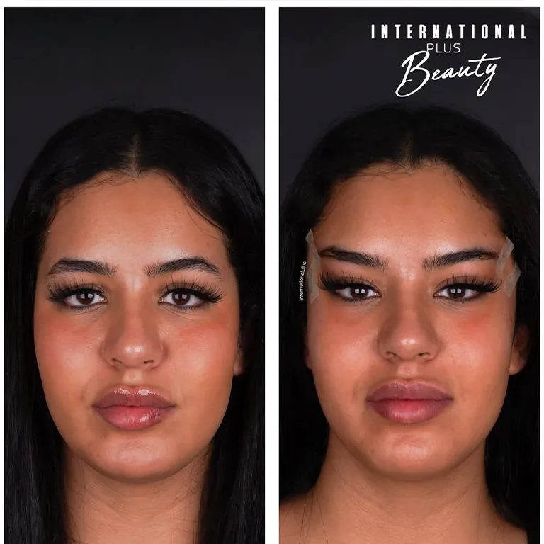 Bella Hadid Eye Surgery