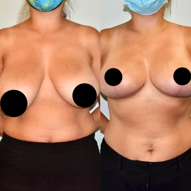 Breast Reduction Scars