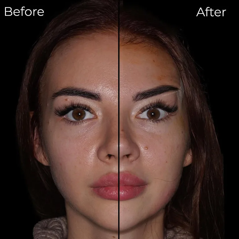 Canthoplasty Turkey