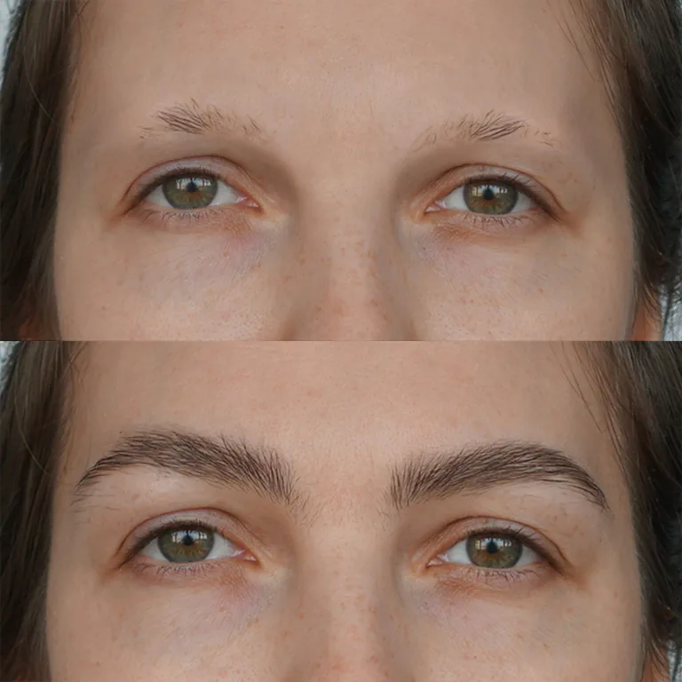 DHI Eyebrow Transplant