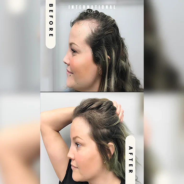 DHI For Female Hair