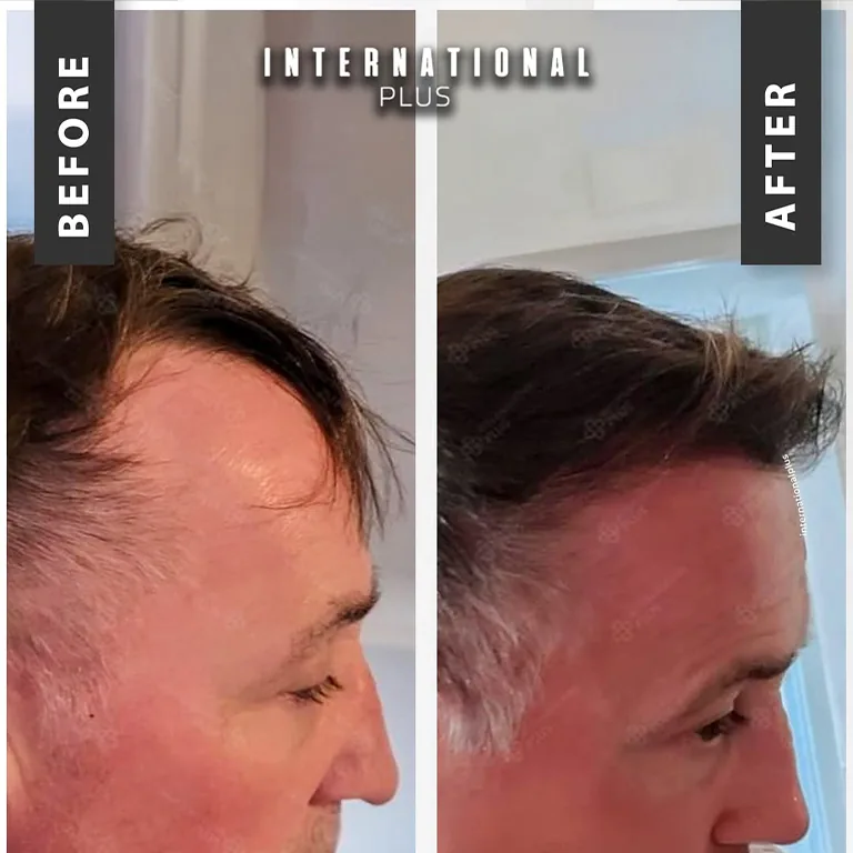 DHI Unshaven Transplant