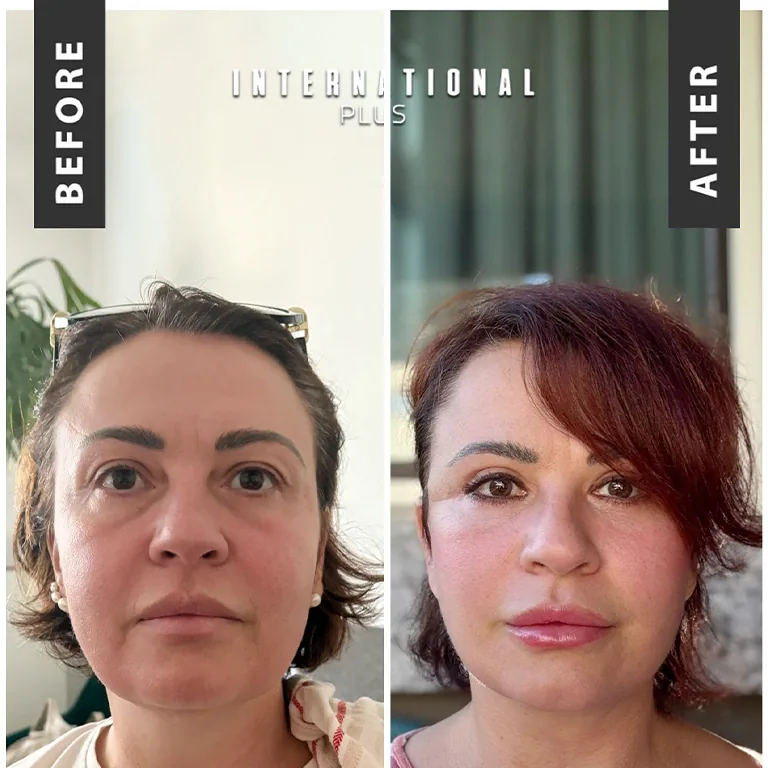 Deep Plane Facelift Before After