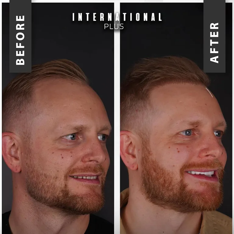 Density With Sapphire FUE