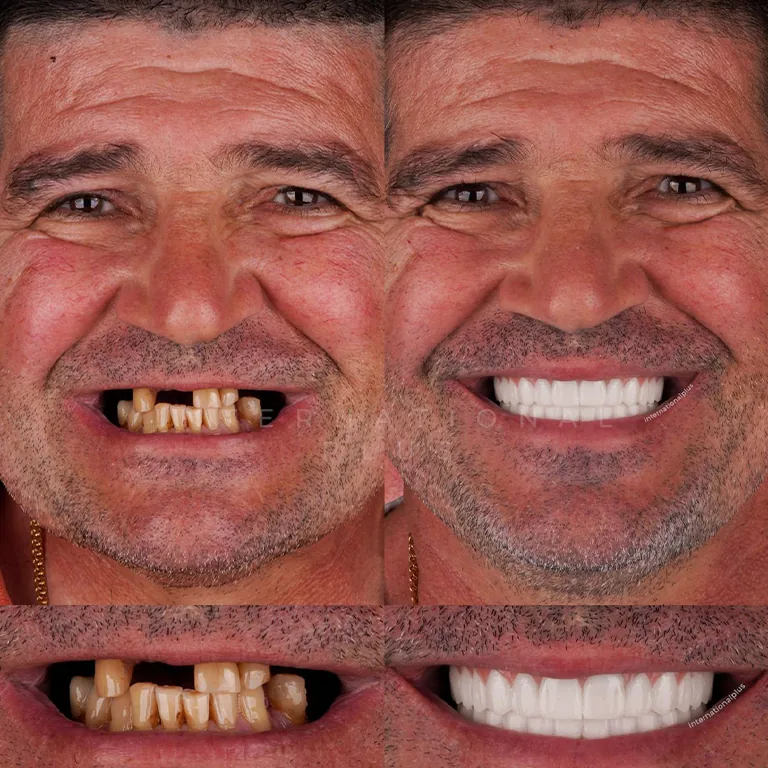 Difference Between Crown and Veneer