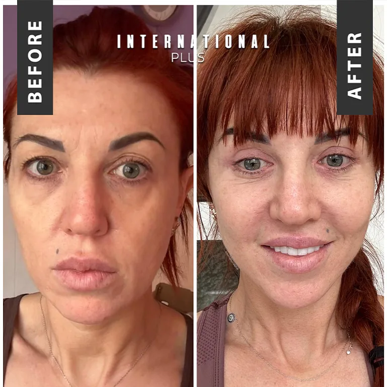 Droopy Eyelid Correction (Upper Blepharoplasty)