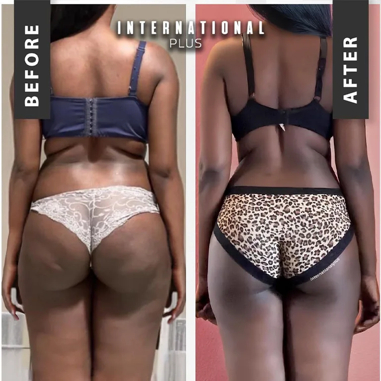 Fat Transfer To Hips