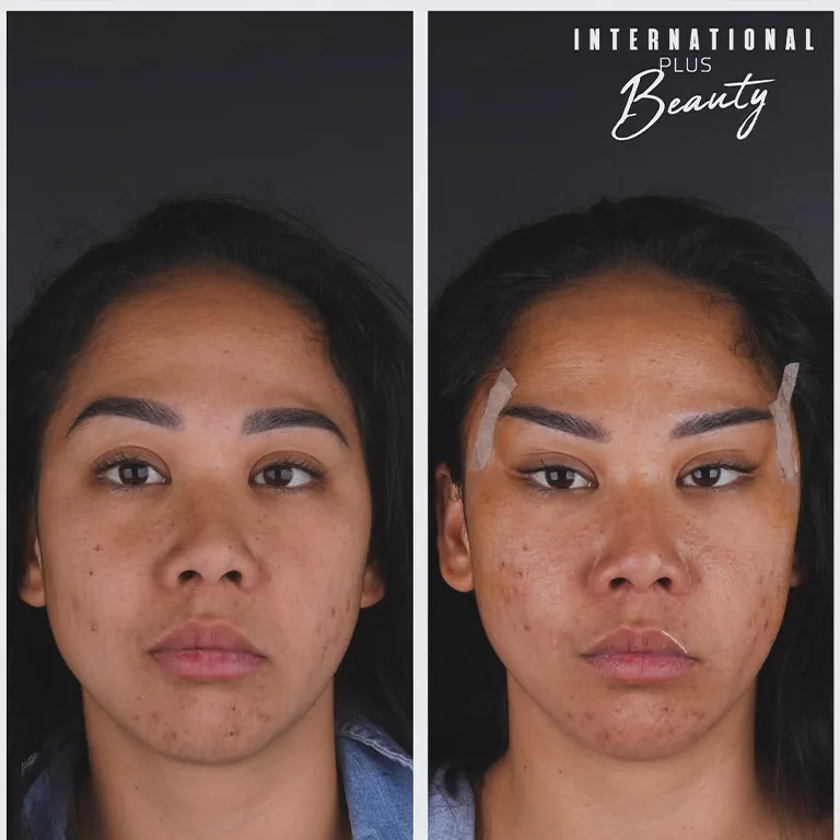 Fox Eye Lift Scars