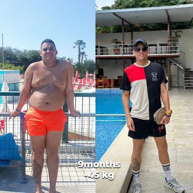 Gastric Botox vs Balloon