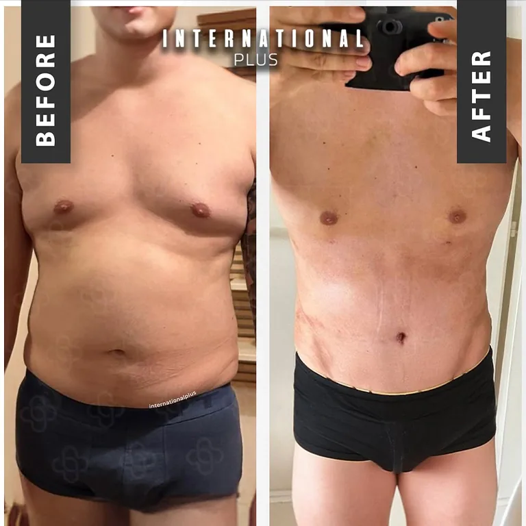 Grade 1 Gynecomastia Treatment