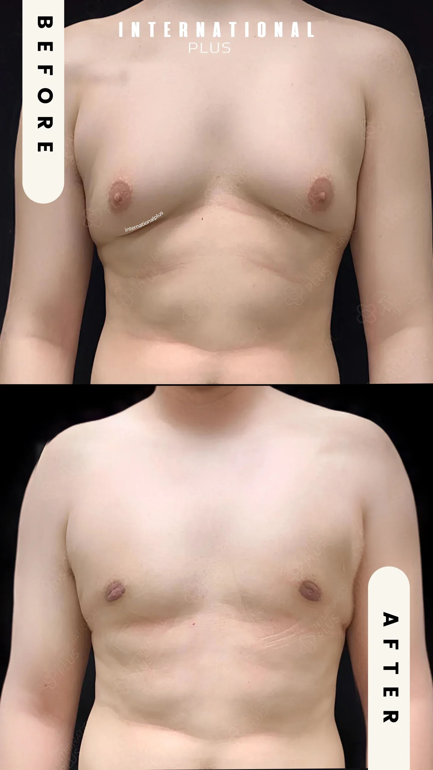 Gynecomastia Surgery Scars