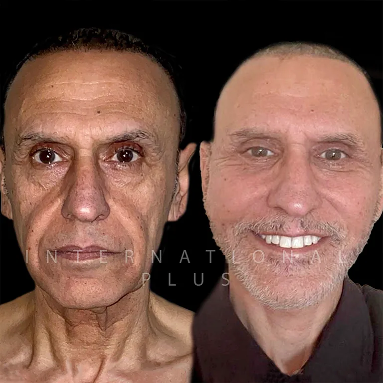 Hollywood Cheek Surgery