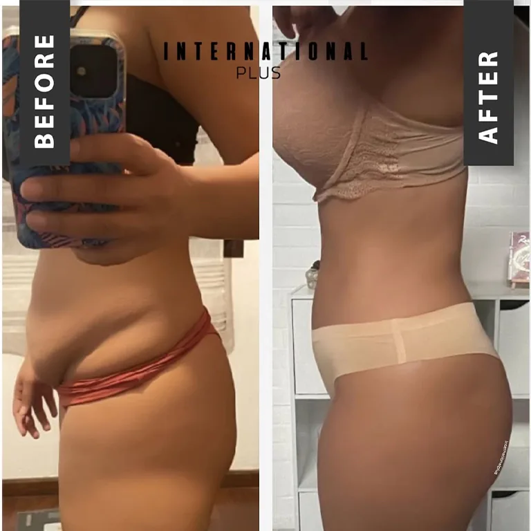 Hourglass Figure Surgery
