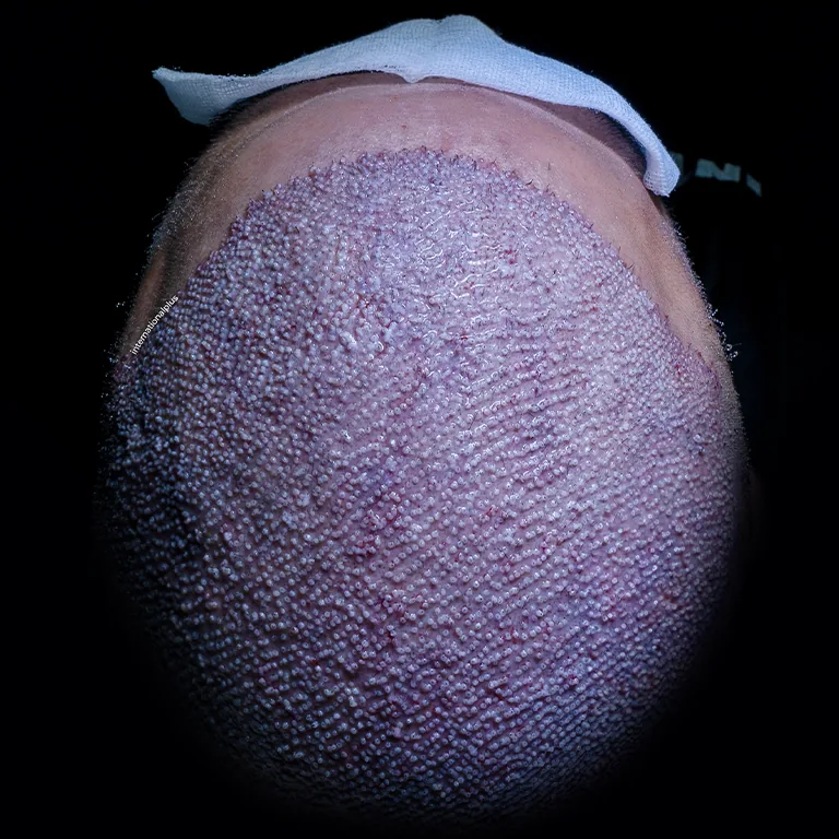 Is 5000 Grafts Safe