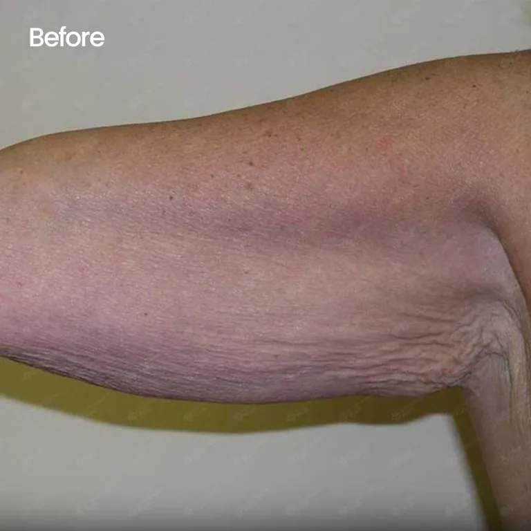 Mini Arm Lift vs Full Arm Lift