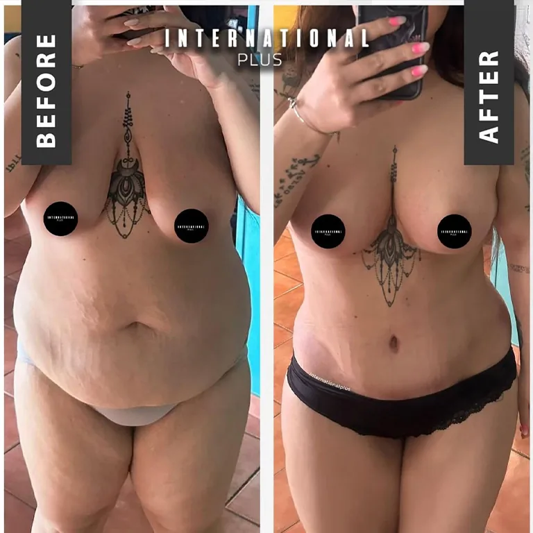 Mommy Makeover Packages