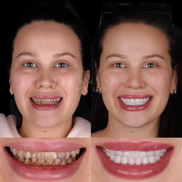 No Prep Veneers Turkey