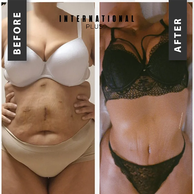 Pain Level BBL Lipo