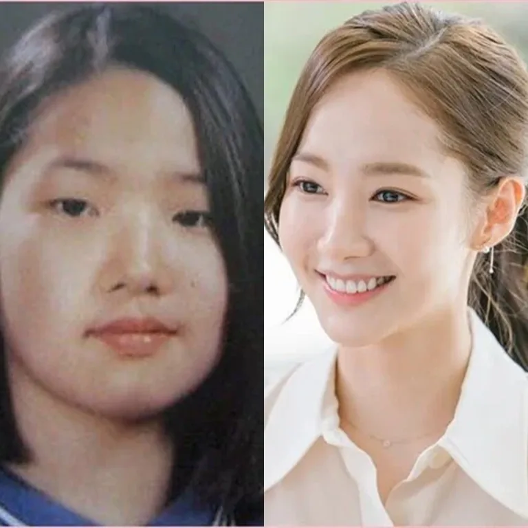 Park Min Young Nose Job