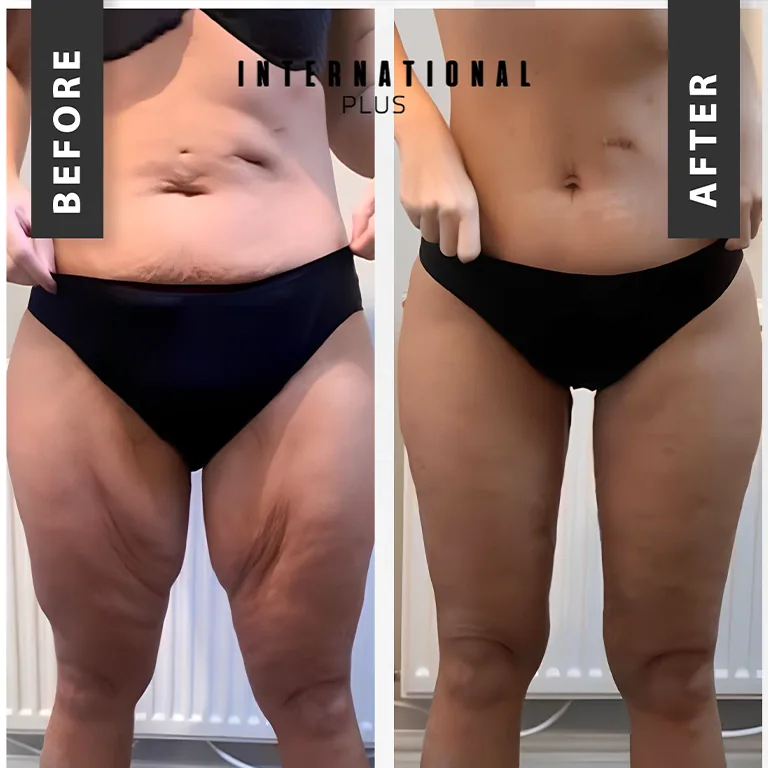 Preventing Loose Skin
