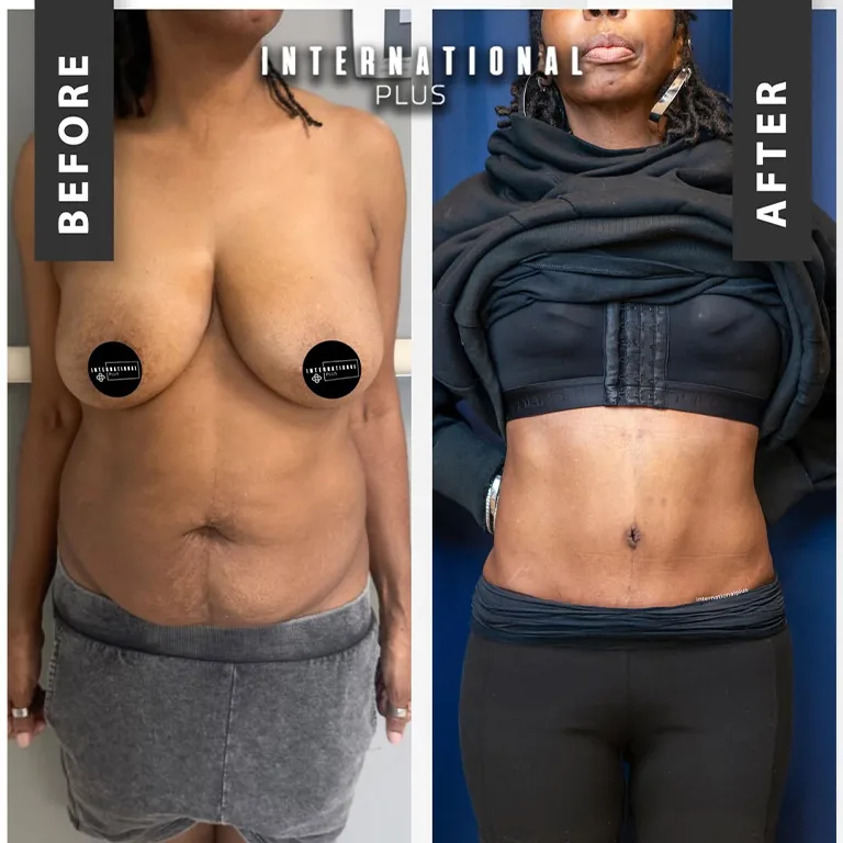 Removing Excess Skin