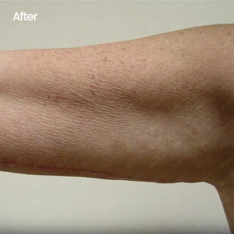Scarless Arm Lift