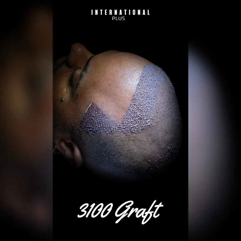 Sleeping After Hair Transplant