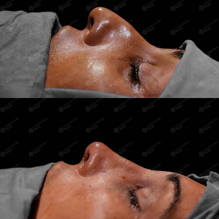 Thick Skin Rhinoplasty Techniques