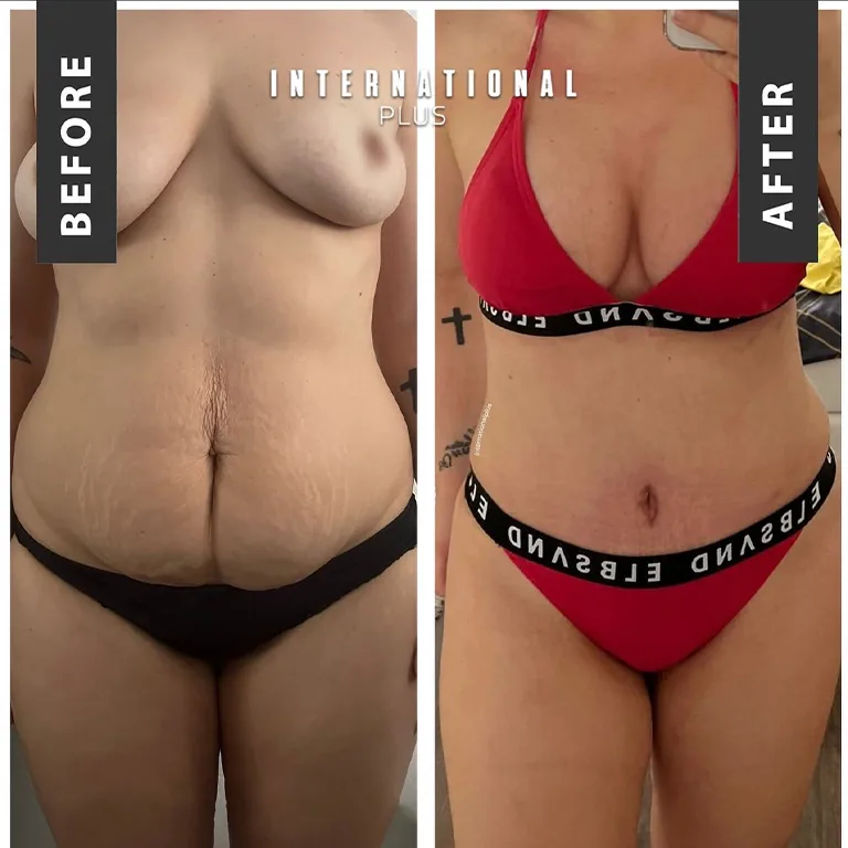 Tummy Tuck Scar Healing