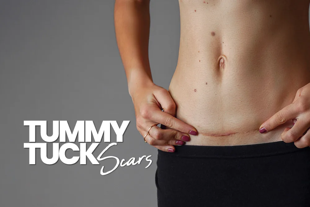 Tummy Tuck Scars