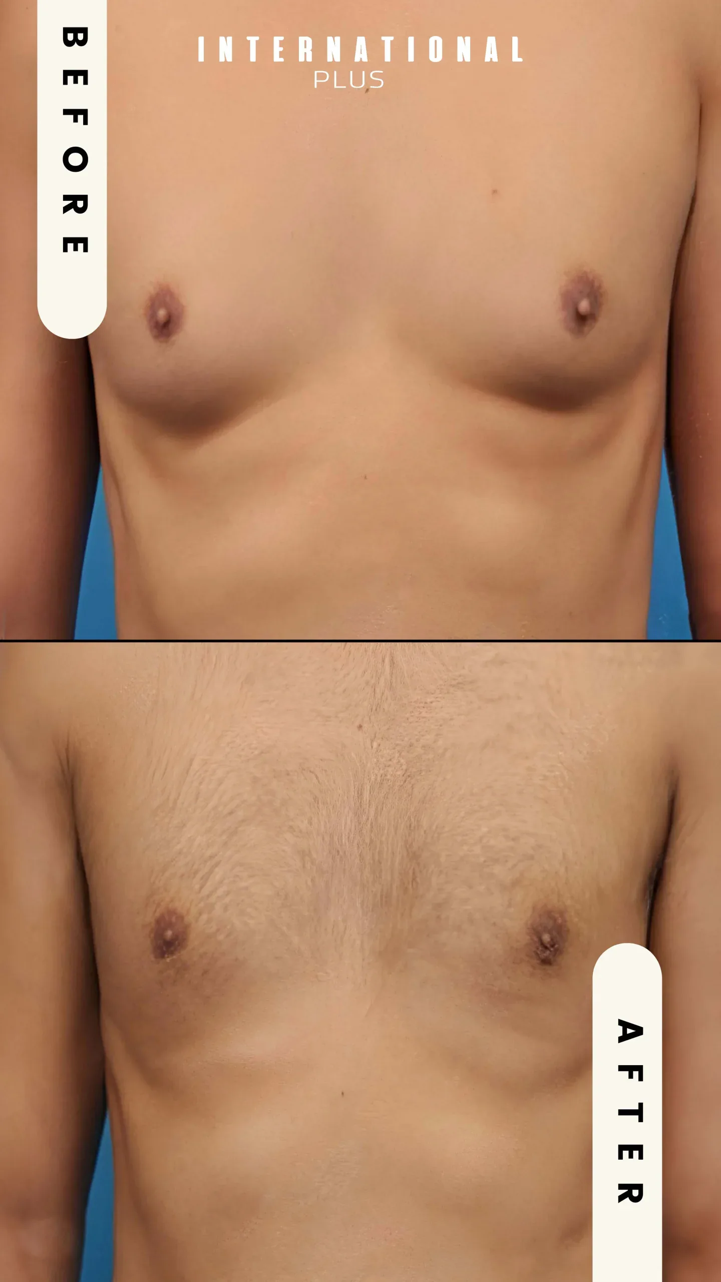 Vaser Lipo For Gynecomastia