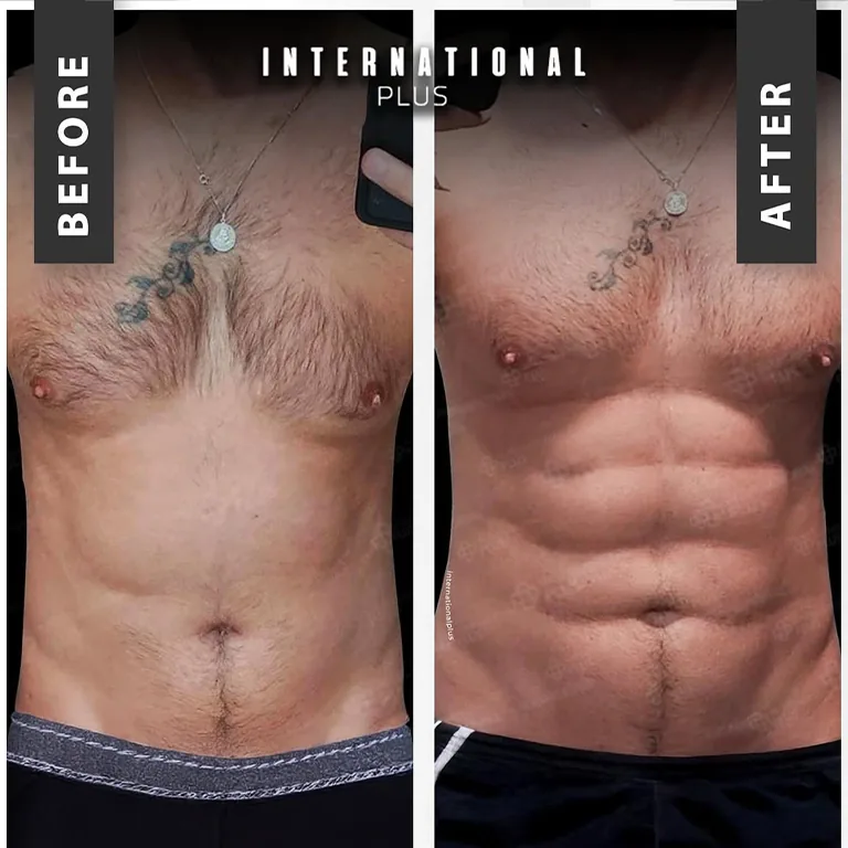 Vaser Lipo High Def