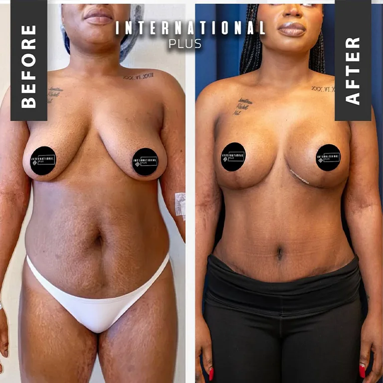 What Includes Mommy Makeover