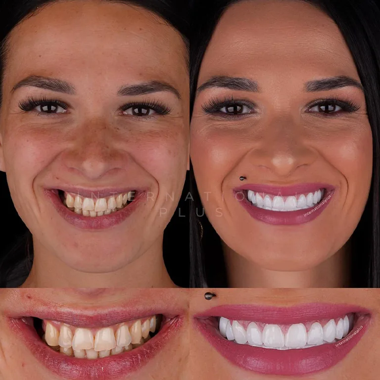 Which Is Better For Molars