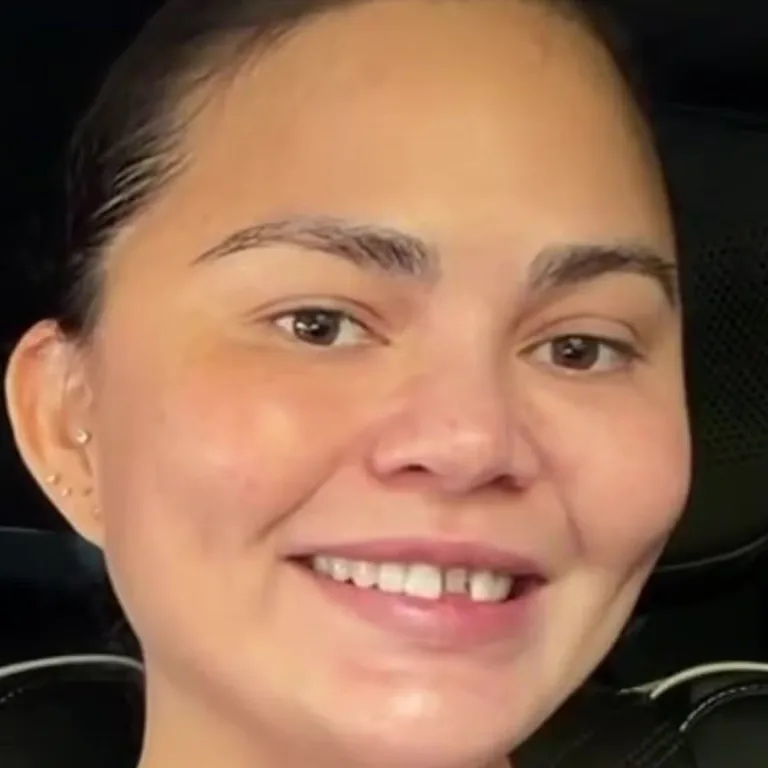 Chrissy Teigen Smile Makeover Transformation