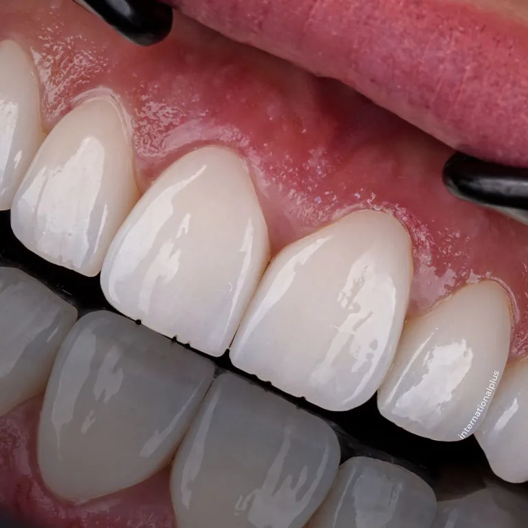 Dental Implant Complications and Risks