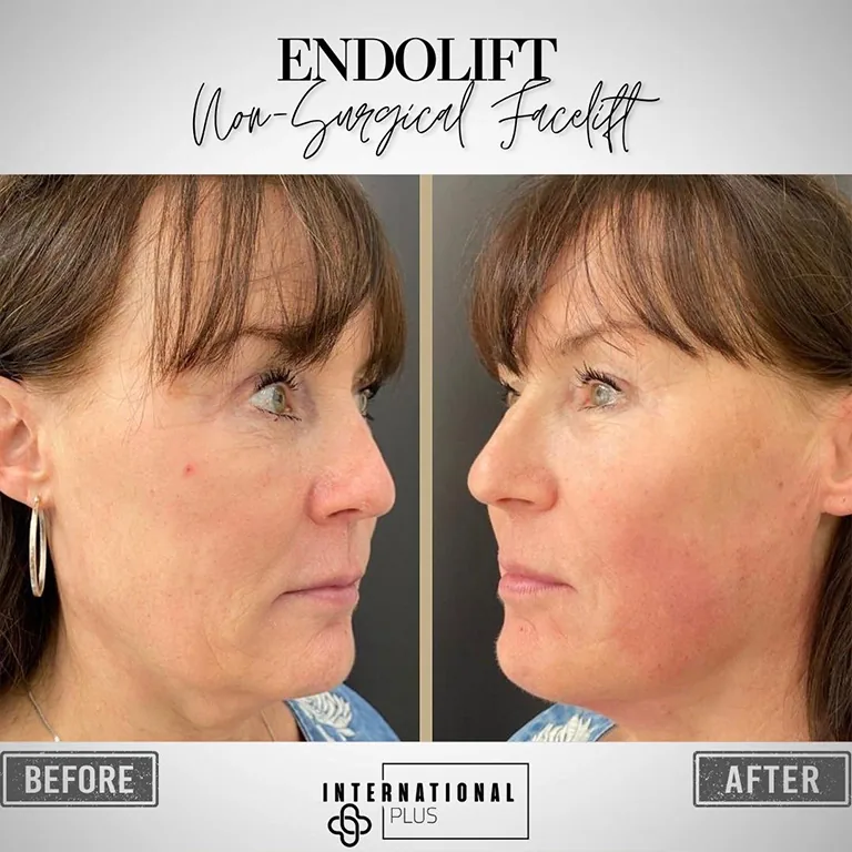 Endolift vs. Traditional Facelift Recovery Comparison